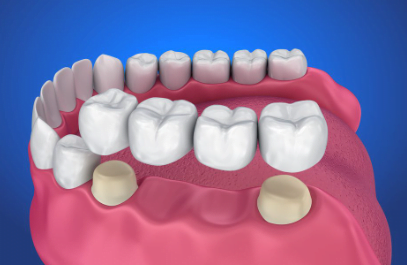 dental bridge cost in karachi