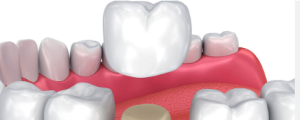 dental crown cost gurgaon