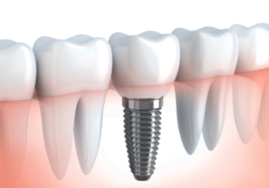 dental implants cost in government hospital in mumbai