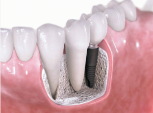 dental implants cost in philippines