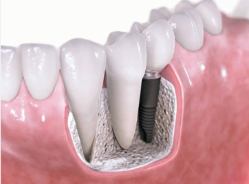 dental implants cost in philippines