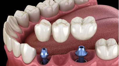 dental implants in san antonio texas