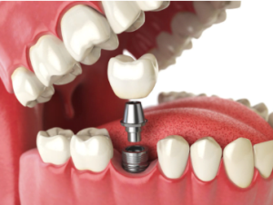 full mouth dental implants cost indiana