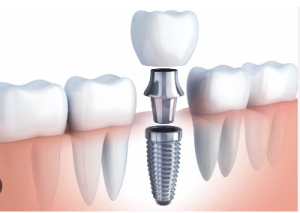 $399 Dental Implants in Las Vegas