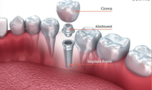 $399 Dental Implants