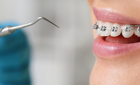 $40 tooth extraction auckland