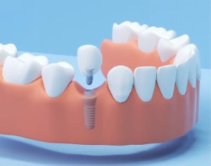 $800 Dental Implants