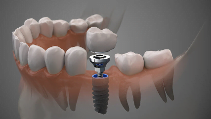 $99 a month dental implants