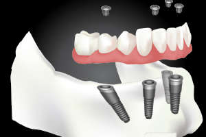 All on 4 Dental Implants Cost Vietnam