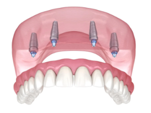 A All-on-4 Dental Implants cost Adelaide