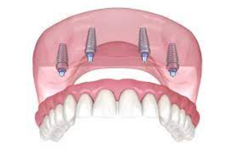 All-on-4 Dental Implants in Arizona