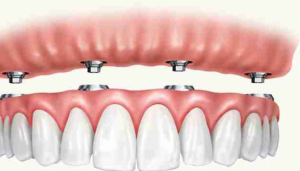 All-on-4 Dental Implants cost in Texas