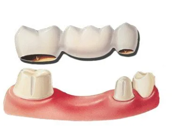 Ceramic Bridge Teeth Cost