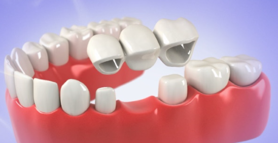 Cost of Dental Bridges in Nigeria