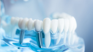 Cost of Dental Implants in San Diego