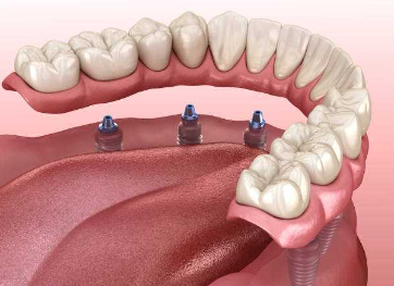 Cost of Dental Implants in Trinidad and Tobago