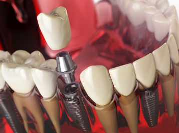 Cost of Dental Implants in Washington State