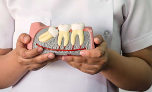 Cost of Wisdom Tooth Extraction in Mumbai