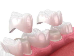 Dental Crowns cost in Mexico