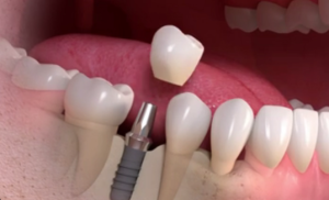 Dental Implant Cost in Jamaica