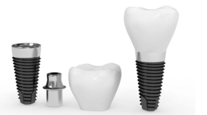 Dental Implants Under $1000