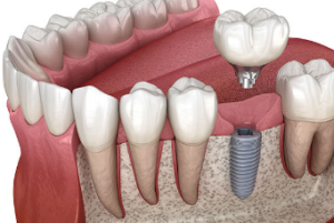 Dental Implants Under $2000