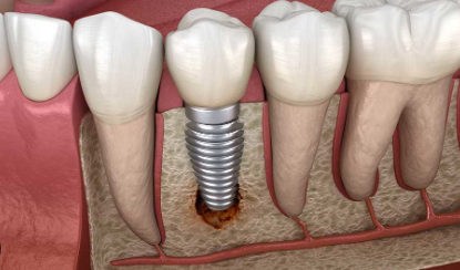 Dental Implants Under $500