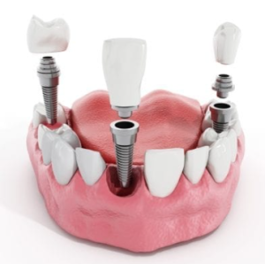 Dental Implants cost in Zimbabwe