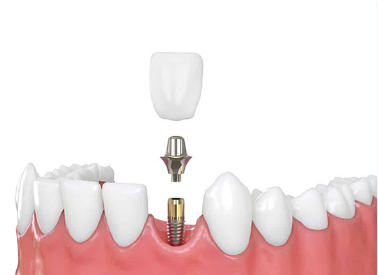 Free Dental Implants in Adelaide