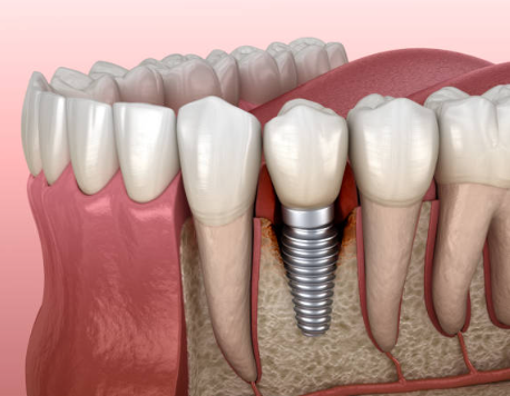 Free Dental Implants in Mumbai