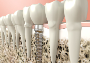 Low-Cost Dental Implants in Massachusetts