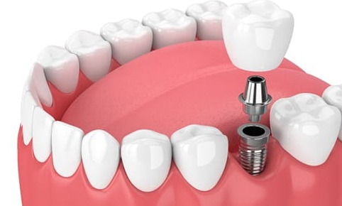 Low-Cost Dental Implants in Oklahoma