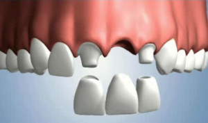 Magkano ang Fixed Bridge Teeth Price Philippines