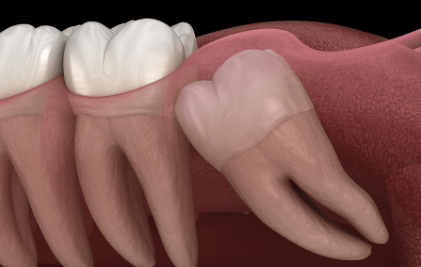 Cost To Have Molar Extracted