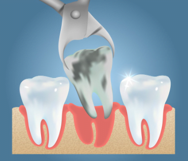 Rotten tooth extraction cost