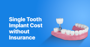 Understanding the Investment: A Comprehensive Guide to Single tooth implant cost without insurance