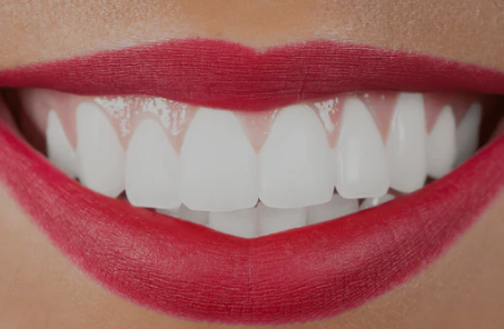 Teeth Bonding Costs in Jamaica