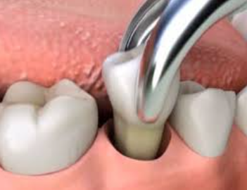 Tooth Extraction Cost in Durban