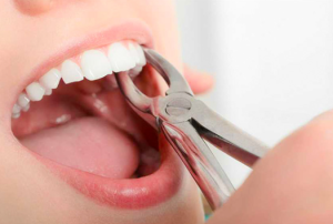 Tooth Extraction cost in Jamaica