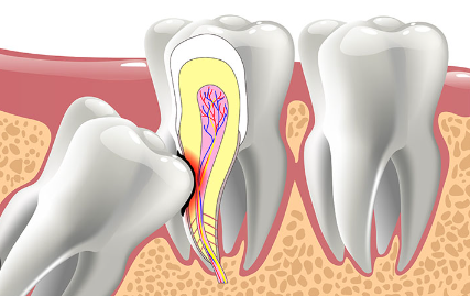 Wisdom Teeth Removal Cost South Africa