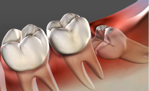 Wisdom Teeth Removal Costs in Richmond