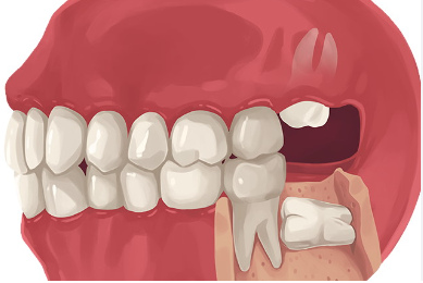 Wisdom Tooth Extraction Costs