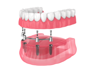 all-on-4 dental implants cost in florida