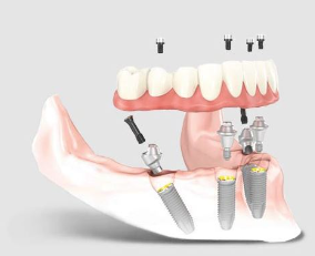 all on 4 dental implants cost spain