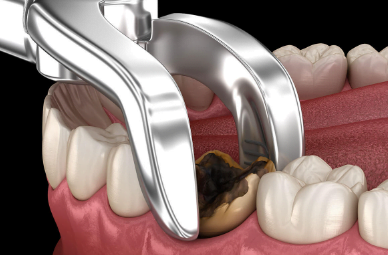 average cost of tooth extraction by oral surgeon