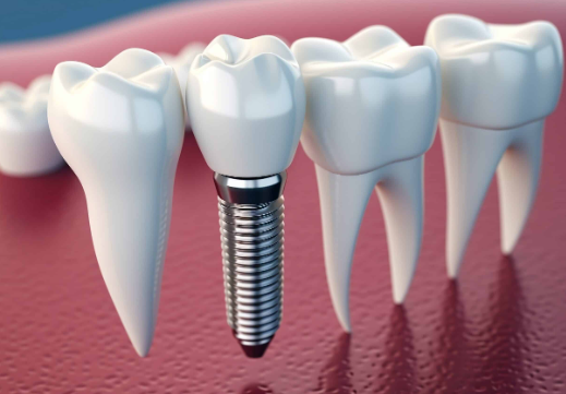 cheapest dental implants in canada