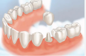 cost of dental bridges in kenya