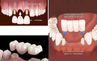 cost of dental bridges in uganda