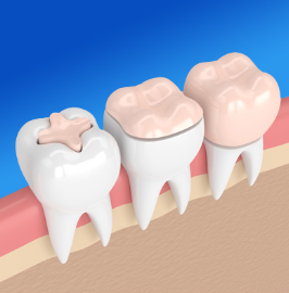 cost of dental crown in costa rica