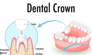 cost-of-dental-crowns-in-colombia